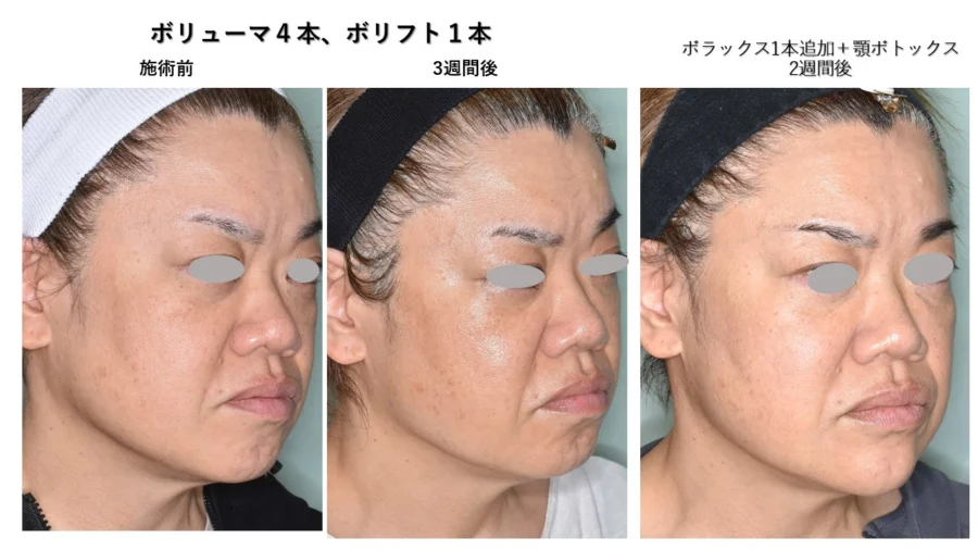 ヒアルロン酸 | 身原皮ふ科・形成外科クリニック