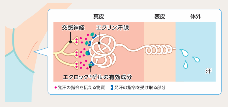 多汗症について