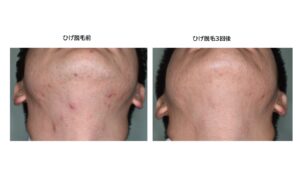 【院長コラム】 医療脱毛は何回で終わる？ 永久脱毛は可能？ 産毛には効く？