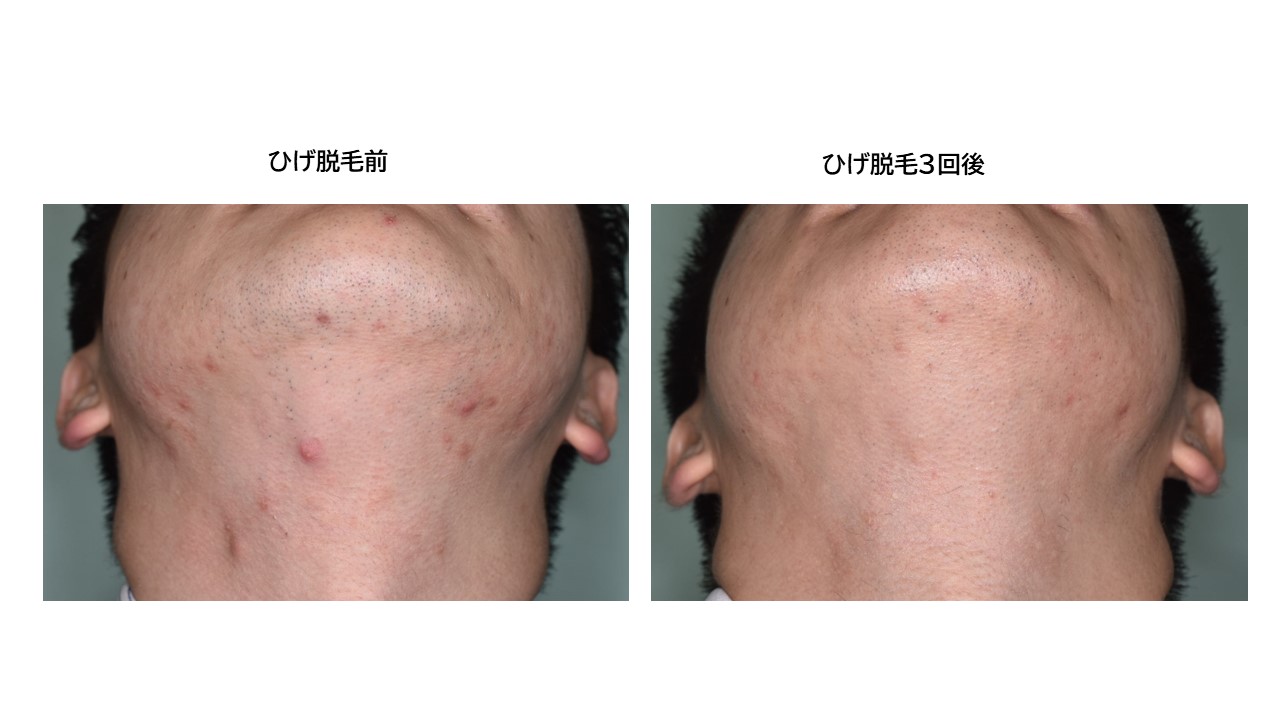 医療脱毛は何回で終わる? 永久脱毛は可能? 産毛には効く?