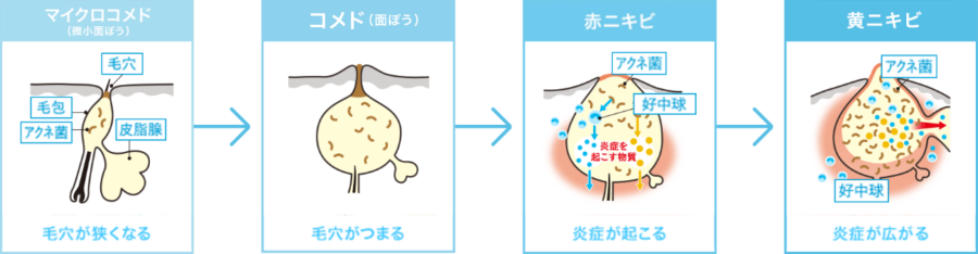 ニキビの発生段階