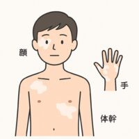 尋常性白斑（しんじょうせいはくはん）の最新治療法｜2025年版ガイドラインからわかる正しい診断と治療