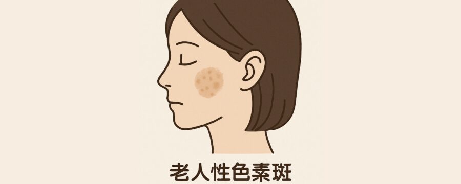 老人性色素斑