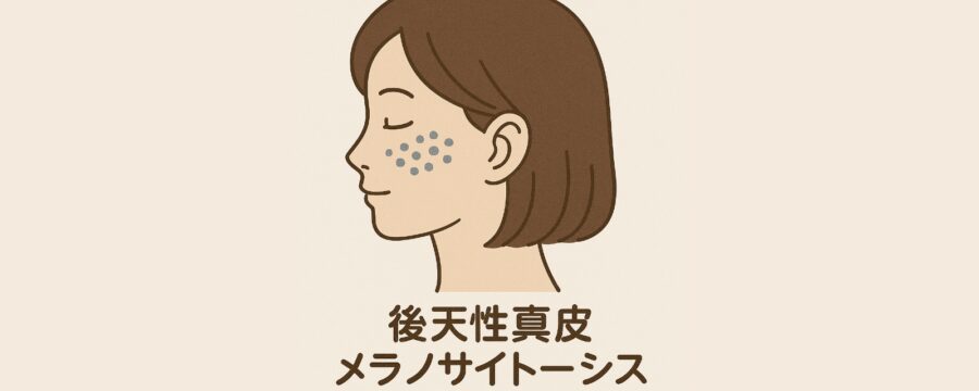 後天性真皮メラノサイトーシス