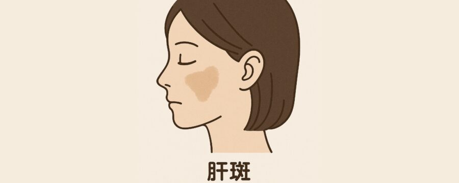 肝斑