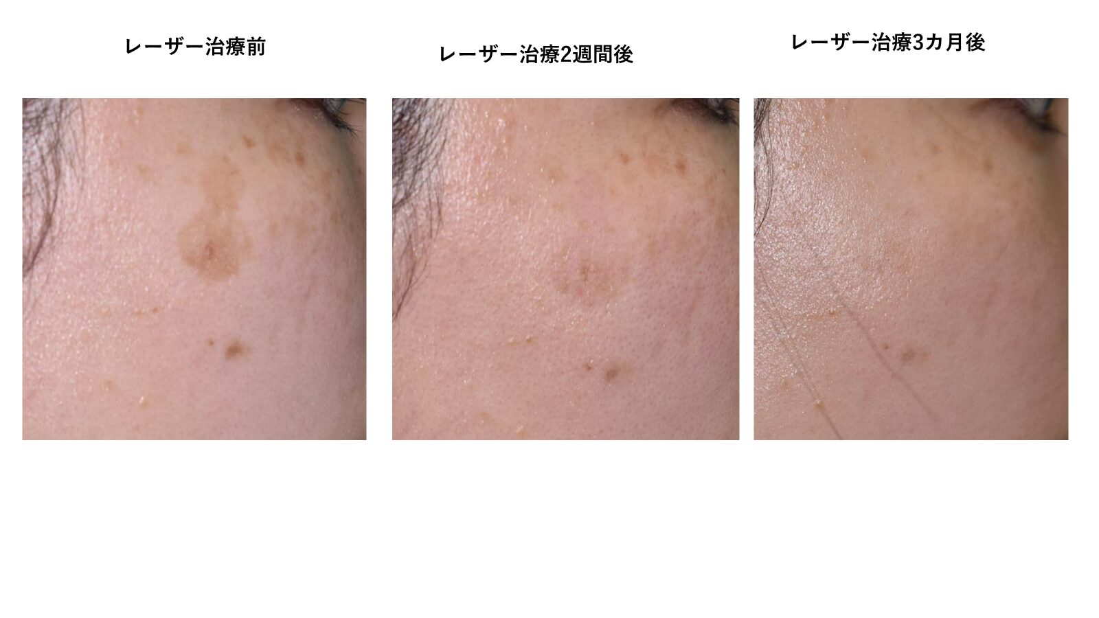 ヤーマン　フォトレーザー　脱毛！シミ取り！ ヤーマンフォトレーザー脱毛！シミ取り！