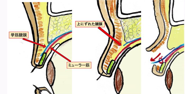 腱膜性眼瞼下垂の手術