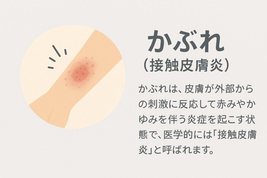かぶれ