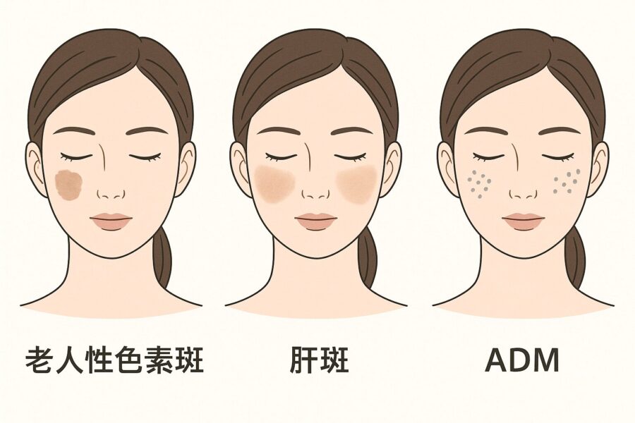 老人性色素斑・肝斑・ADM