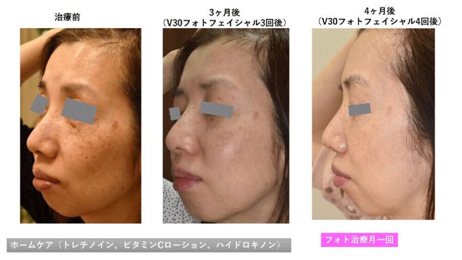 V-IPL(光治療)の経過