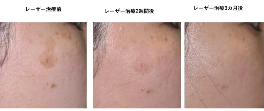 StarWalker® | 身原皮ふ科・形成外科クリニック