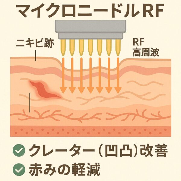 サーマニードルの仕組み